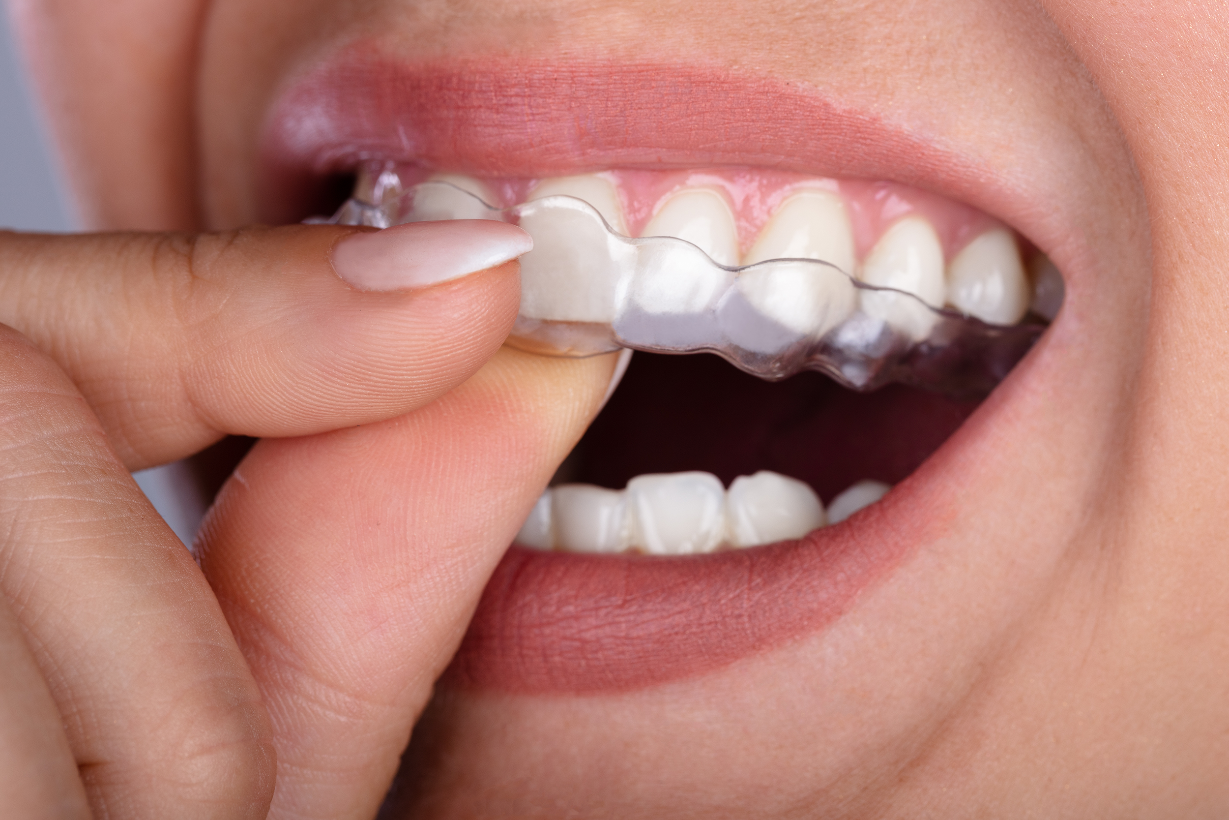 clear aligner therapy