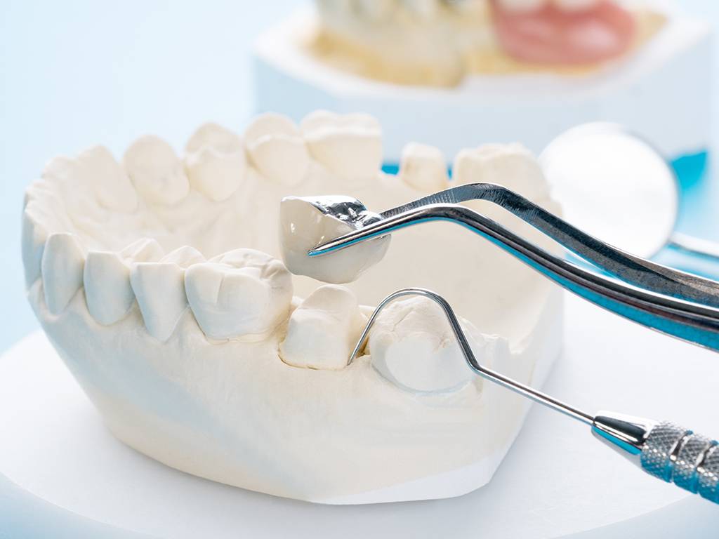 What Is a Dental Crown and Why Would You Need One?