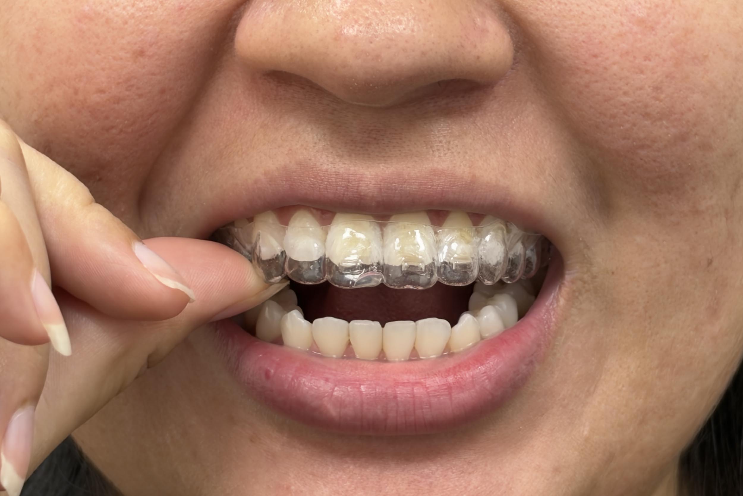 woman with invisalign